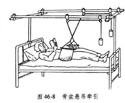 骨盆兜带悬吊牵引图片