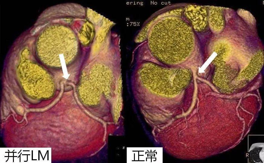 msct對cabg術後橋血管的評估價值 冠狀動脈正常解剖 冠狀動脈粥樣