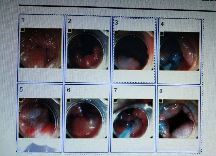 内痔肠镜下图片大全图片