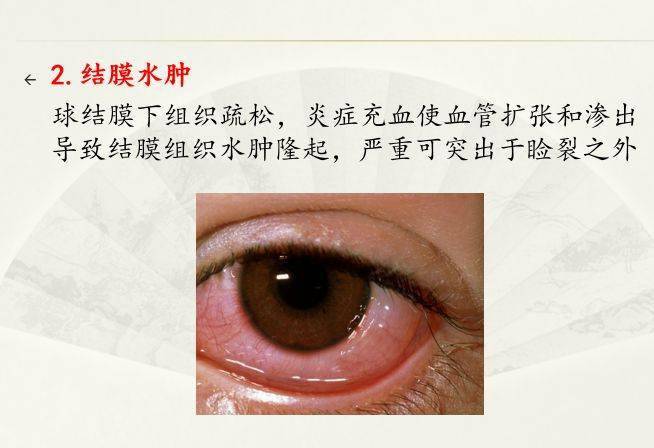 来说,结膜炎的患者会出现一些常见的体征,包括以下几点:1是结膜充血