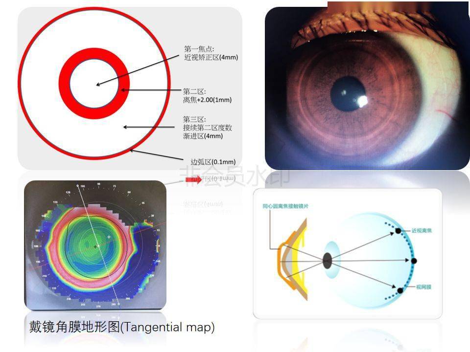 高度舒适感和护理方便明显优于塑形镜.