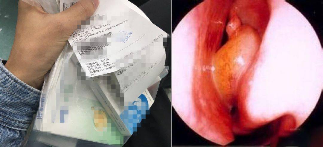 鼻炎真的会让你变丑gmp认证新西兰国民抗鼻炎神器止痒通鼻拒绝口呼吸