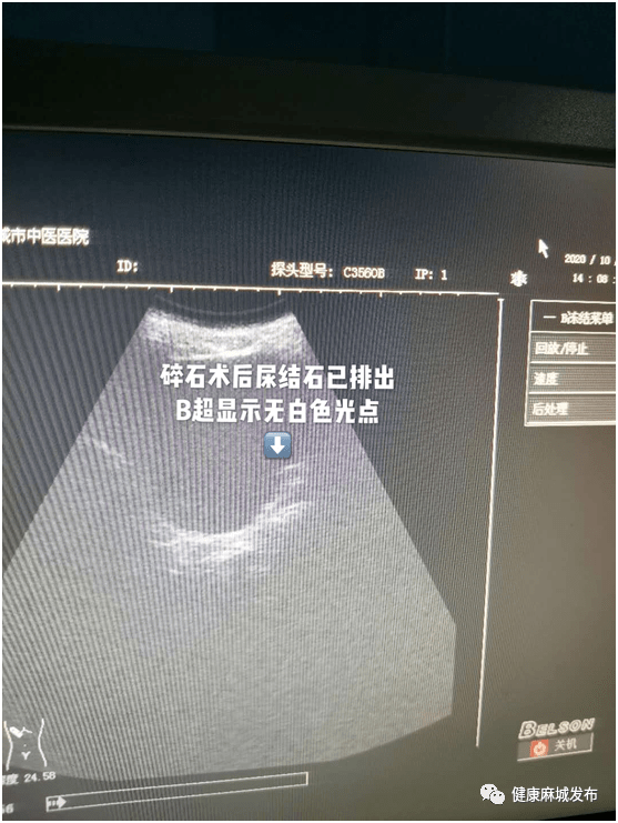 石石牵挂碎碎平安麻城市中医医院开展多例体外冲击波碎石术