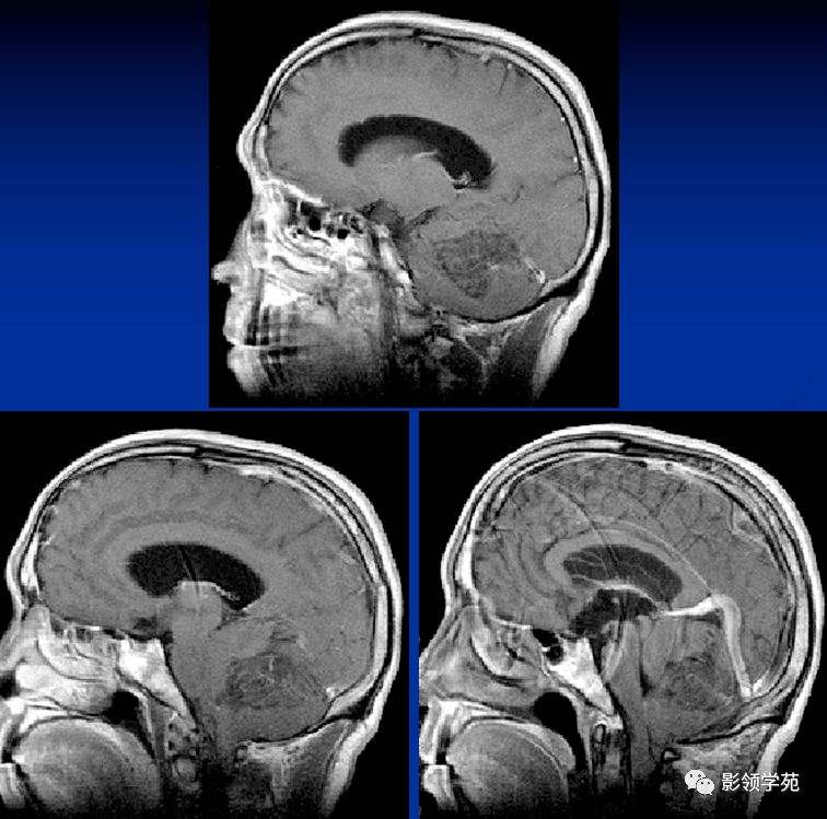 小脑发育不良性神经节细胞瘤的mri诊断