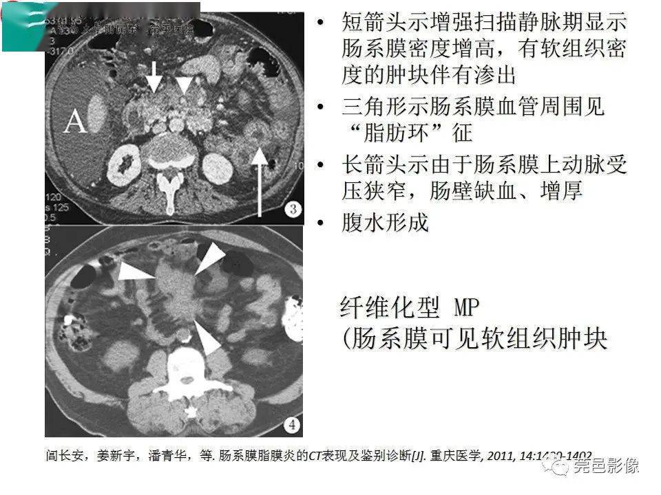 肠系膜根部ct解剖图图片