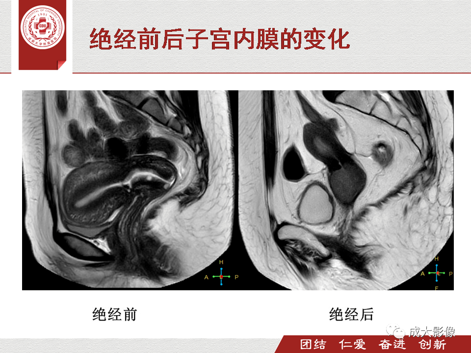 超讚子宮mr掃描規範正常表現及子宮內膜癌的分期