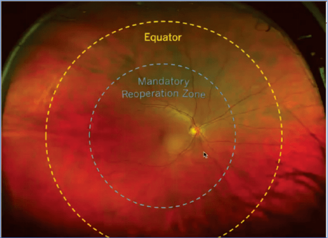 图2所定义,该图描绘了以中央凹为中心的圆,该圆位于拱环和赤道的中间