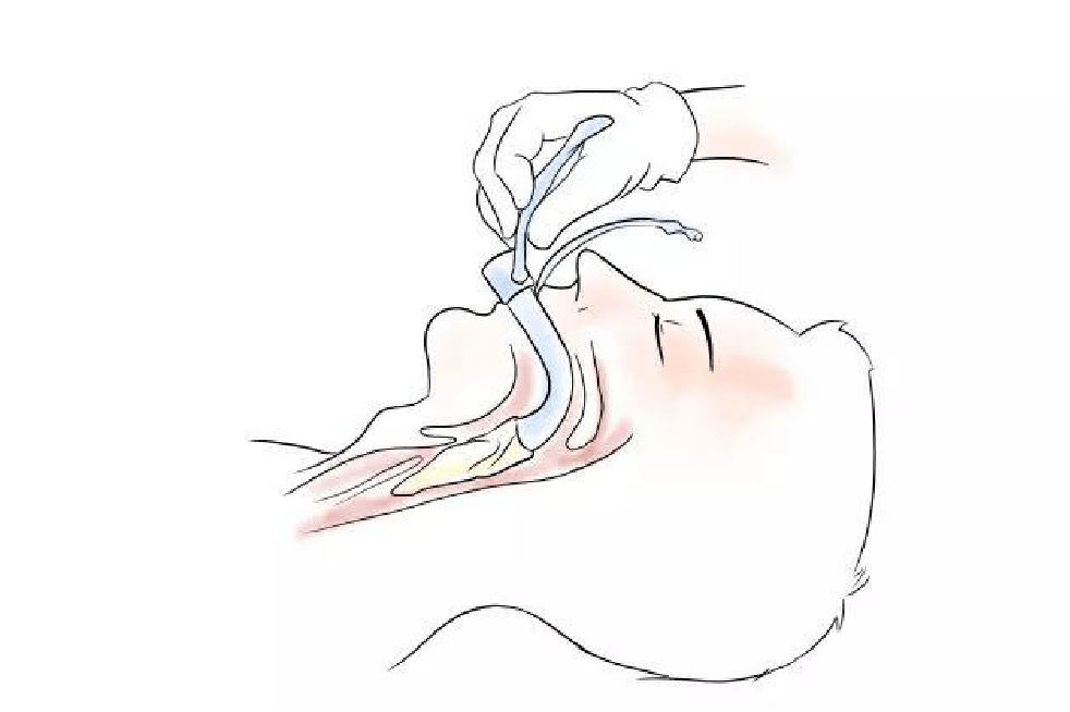 东方15周年庆丨我来科普:手术全麻会让你变傻吗?_麻醉