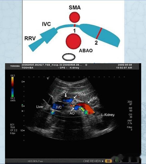肠系膜上动脉压迫综合征与胡桃夹综合征