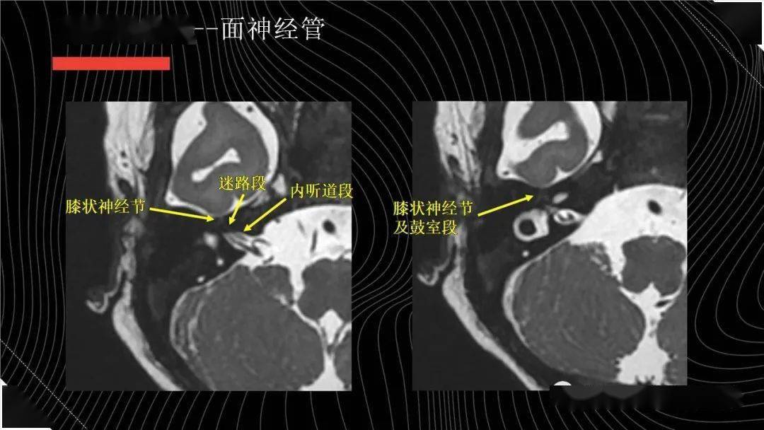 面听神经MRI解剖ppt图片