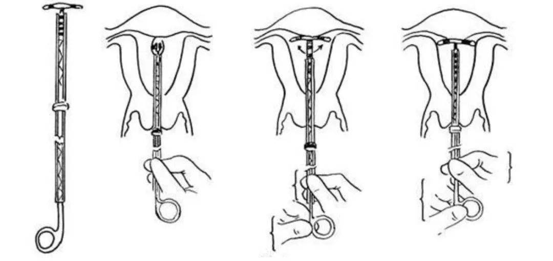 上环的全过程图解图片