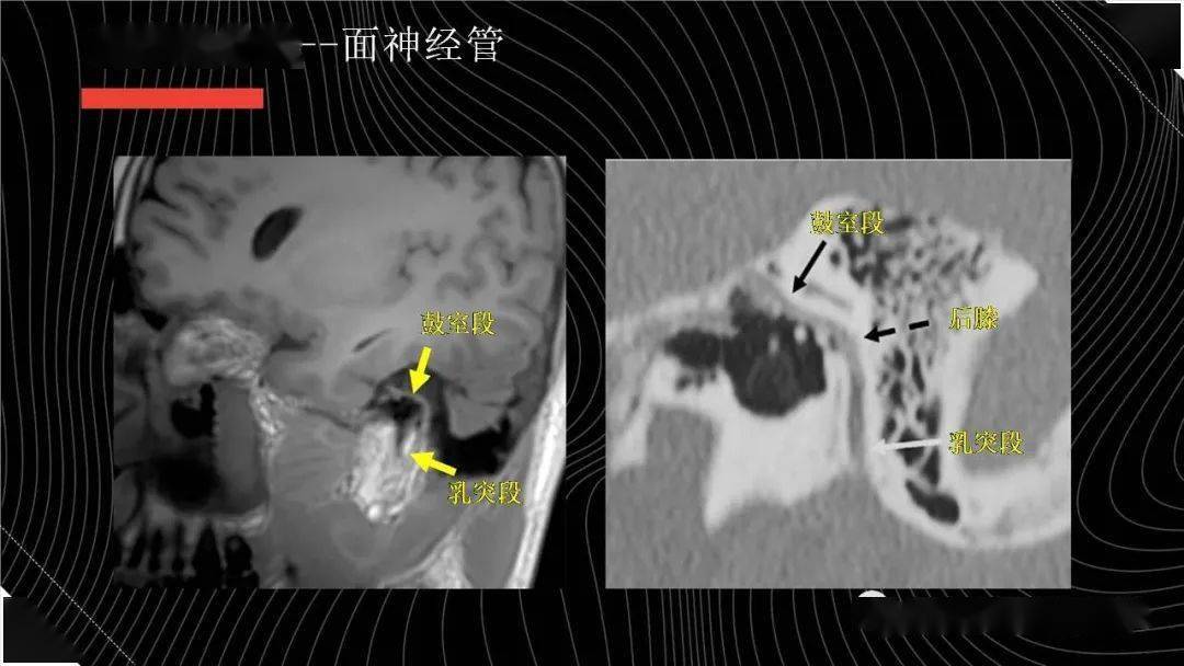 面神经解剖与常见疾病