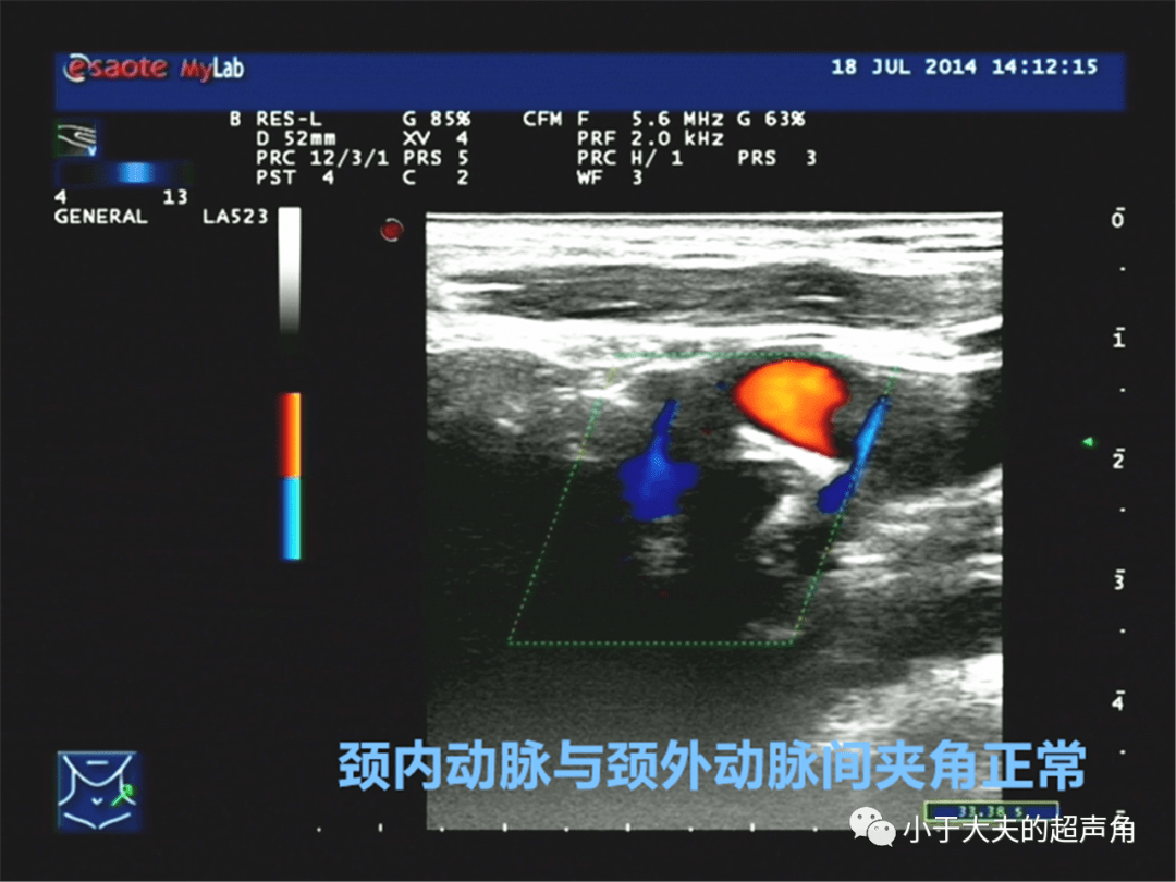 超聲隨響第19期頸動脈體瘤vs神經鞘瘤