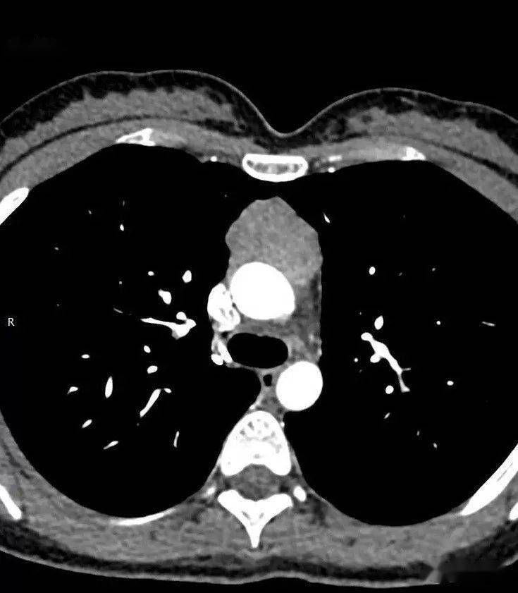 胸腺瘤症状图片