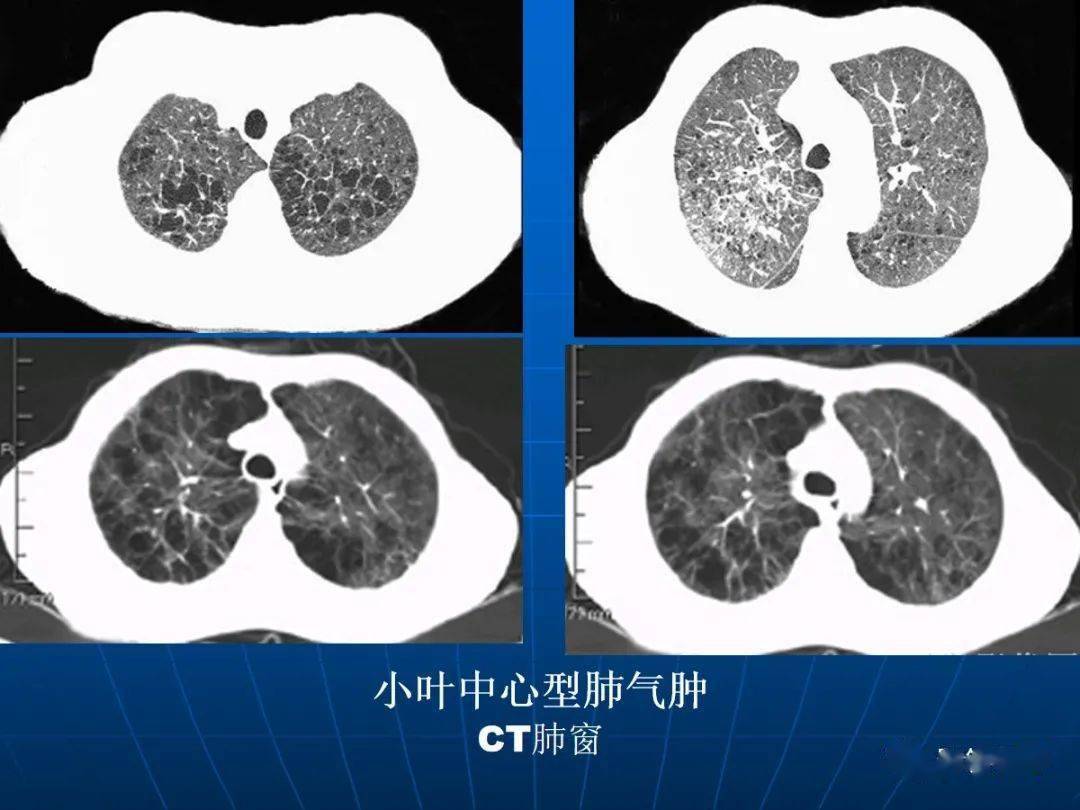肺气肿的影像图片图片