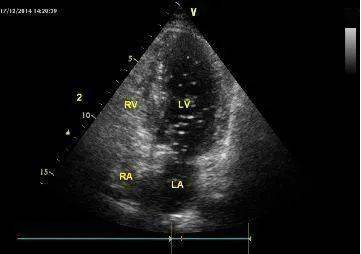 右心声学造影技术头痛不妨查查心