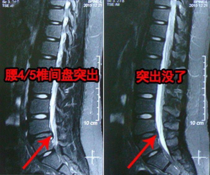 腰椎第四五节位置图图片