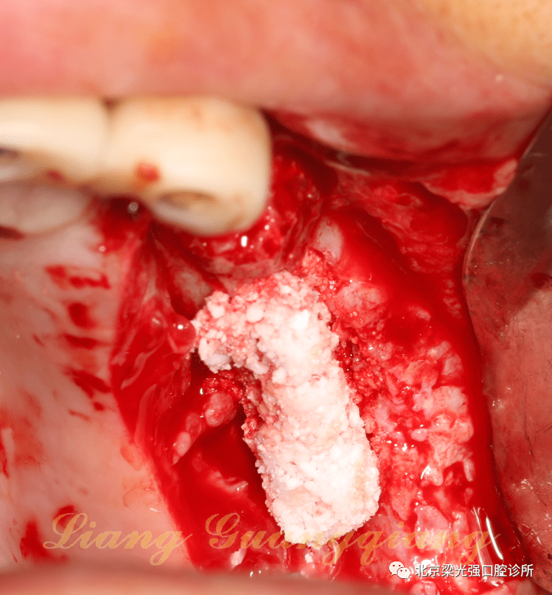 牙医学堂上颌窦膜破裂后二次种植