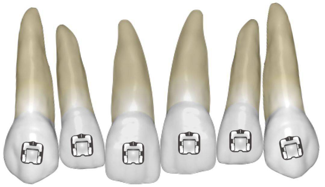 穿过切牙及磨牙的临床冠中心,这样来引导全口托槽的就位,确定托槽的