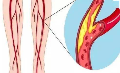 小腿總疼是下肢動脈惹的禍老年人高發的動脈硬化不止在心腦