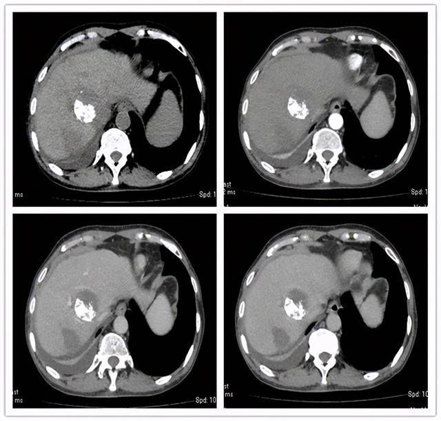 乙肝肝硬化伴原发性肝癌deb-tace治疗cr一例