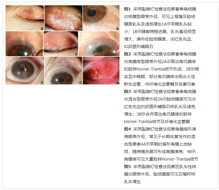 我国过敏性结膜炎诊断和治疗专家共识2018年