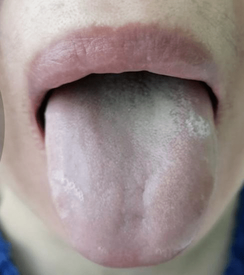 舌质淡苔白腻图片