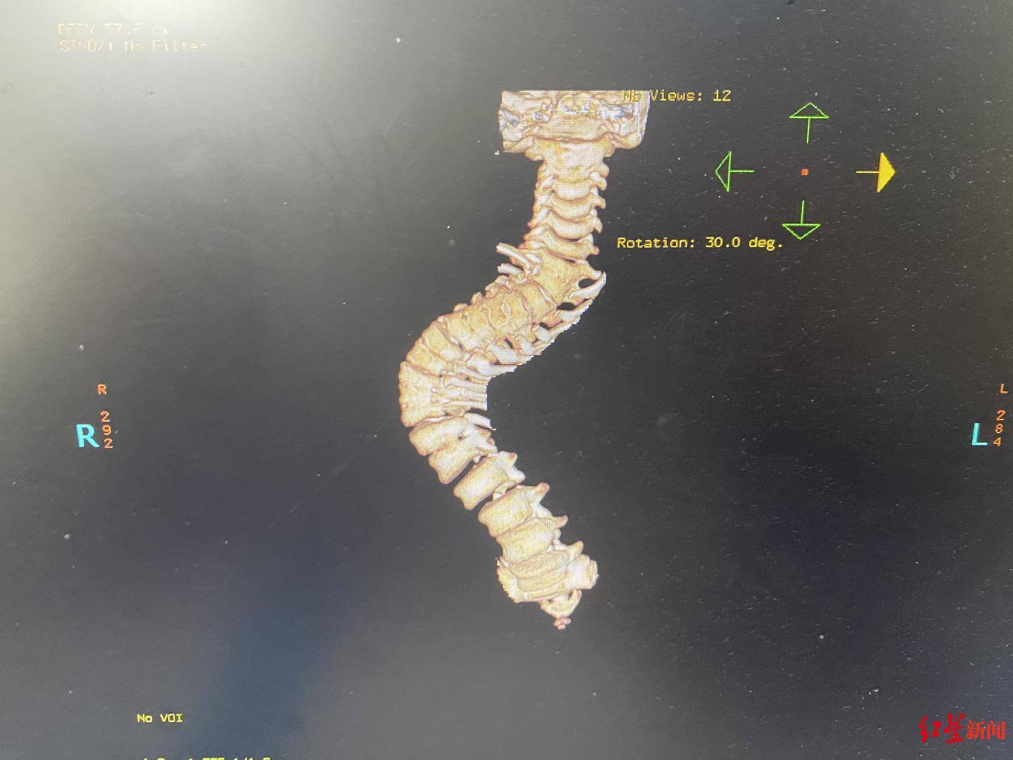8岁折叠人的困境身高仅90厘米脊柱侧弯严重术前又患重症肺炎