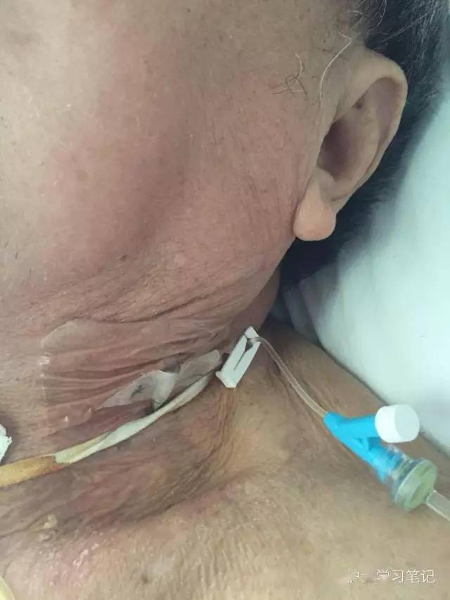 为什么不给他埋个picc? picc算什么,我们连深静脉都搞不进去.