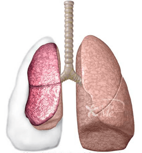 说得通俗点就是爆肺,医学上称之为气胸.