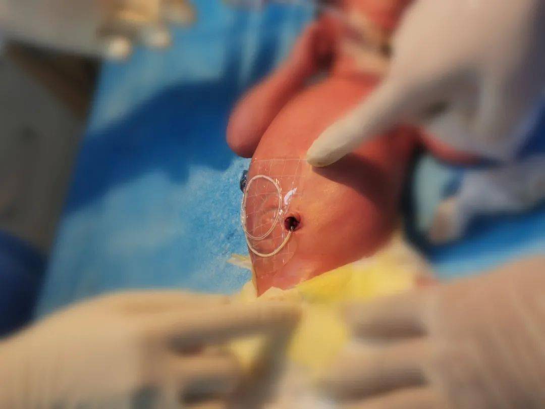 早产儿脐静脉置管图片