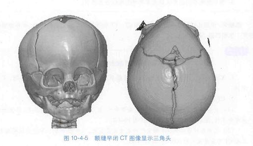 三角头畸形 冠状缝图片