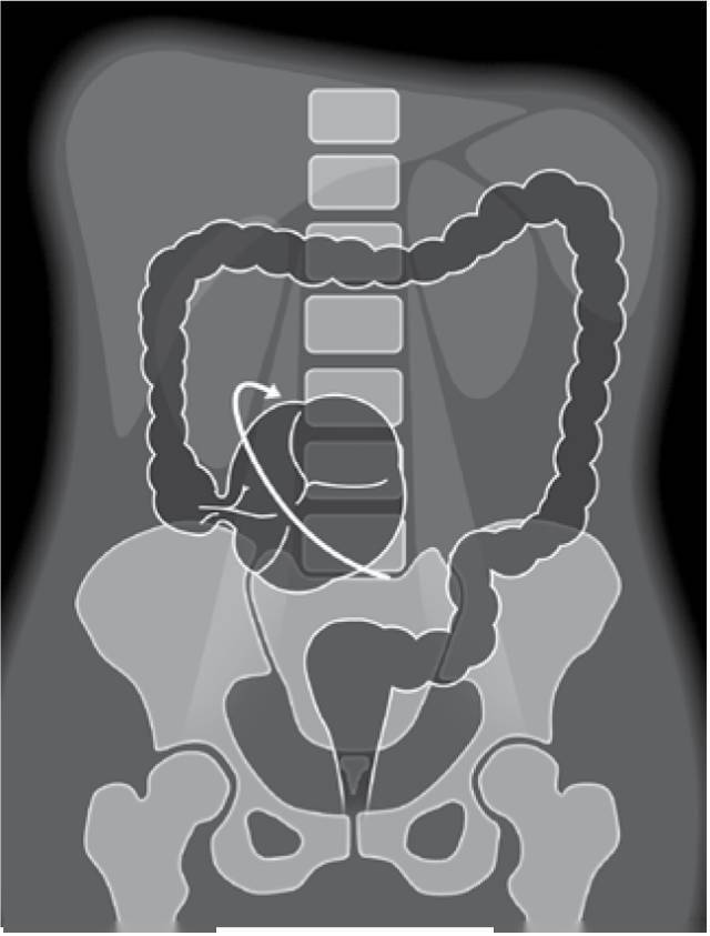 小肠扭转x线图片图片