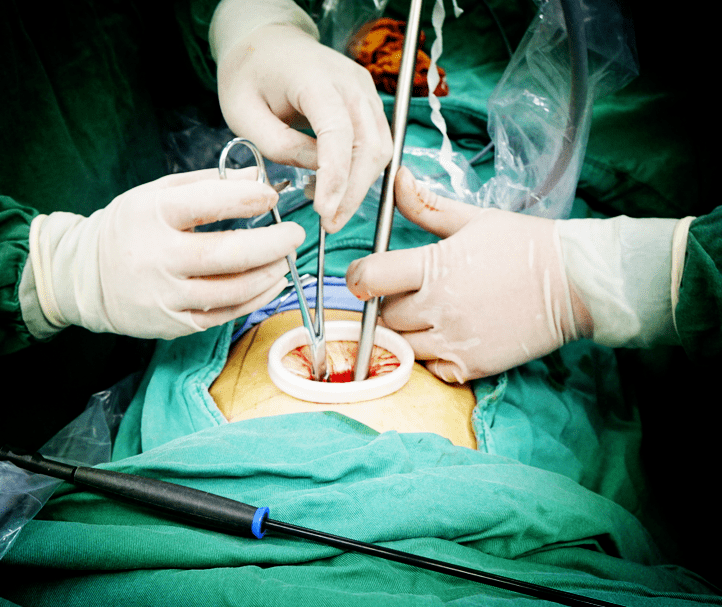 我院经多学科协作成功完成首例单孔电视胸腔镜下肺叶楔形切除手术,为