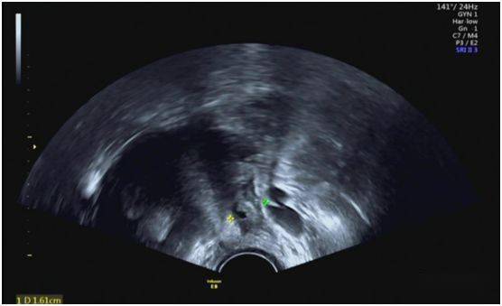 浆液性囊腺瘤超声图片图片