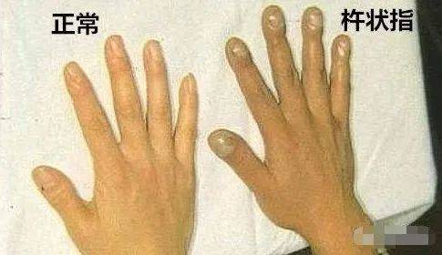 手指出现1种症状赶快去检查下肺癌可能遍布全身