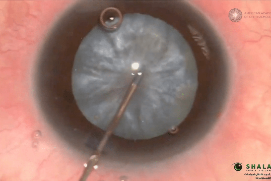 膨胀期白内障手术担心出现阿根廷国旗征这套手术技巧可有效预防术中囊