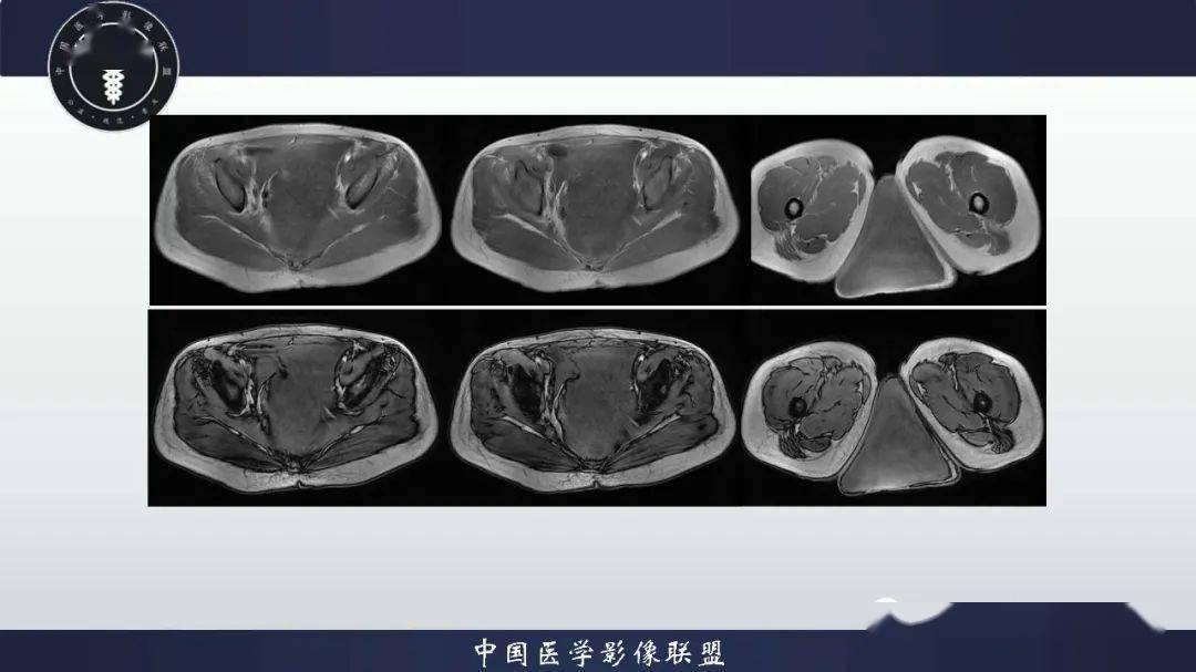 外阴及盆腔丨深部侵袭性血管黏液瘤