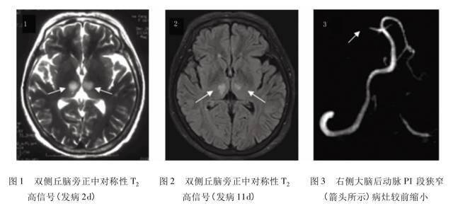 解剖顱內血管丨丘腦血供