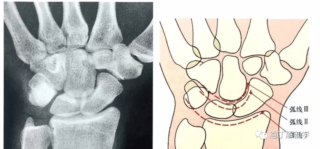 腕关节侧位x线片上桡骨,月骨,头状骨和第三掌骨的中心轴自然形成一条