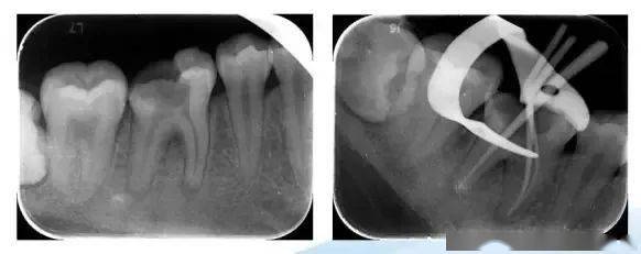 收藏牙髓息肉的治疗方法有图有真相