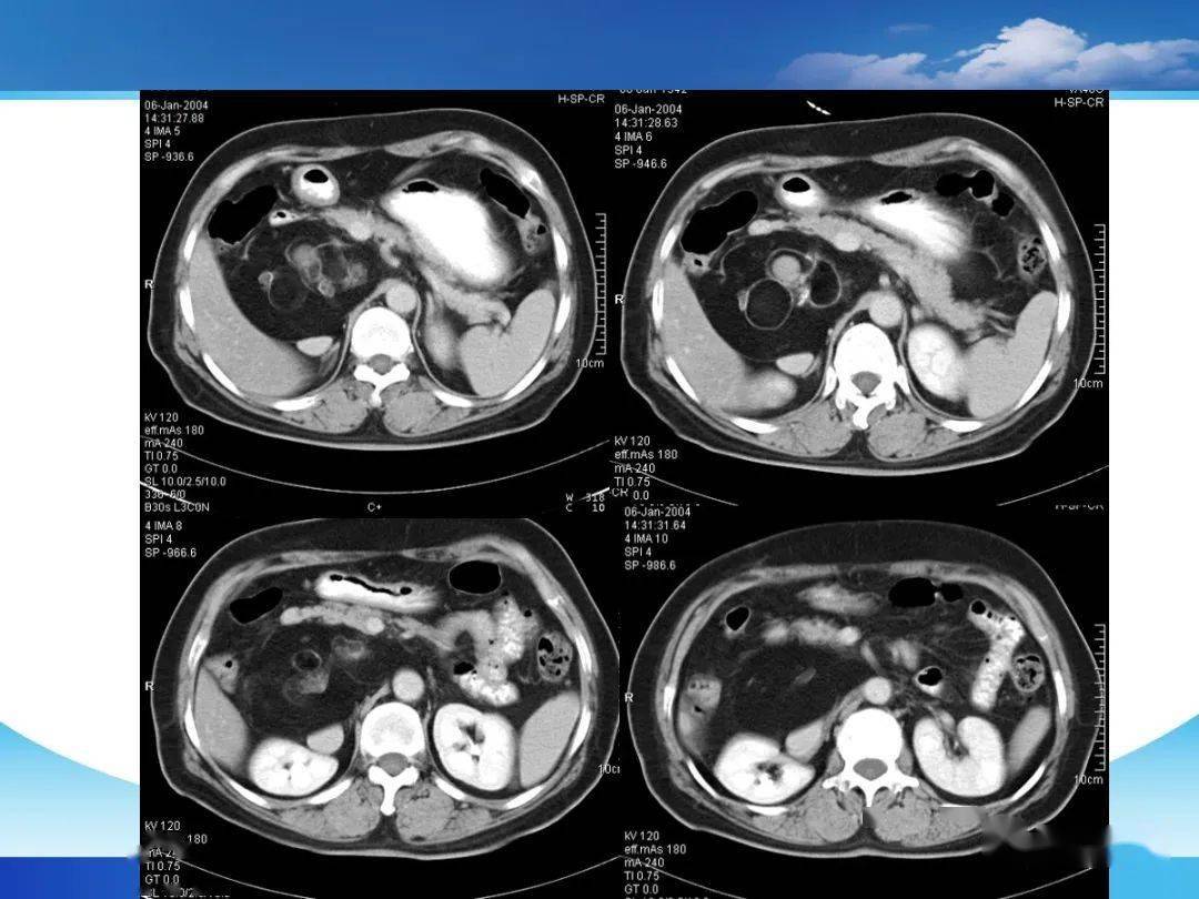 四叠体池脂肪瘤ct图片图片