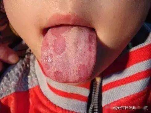 第五种:舌头光滑宝宝舌头光滑,是经常