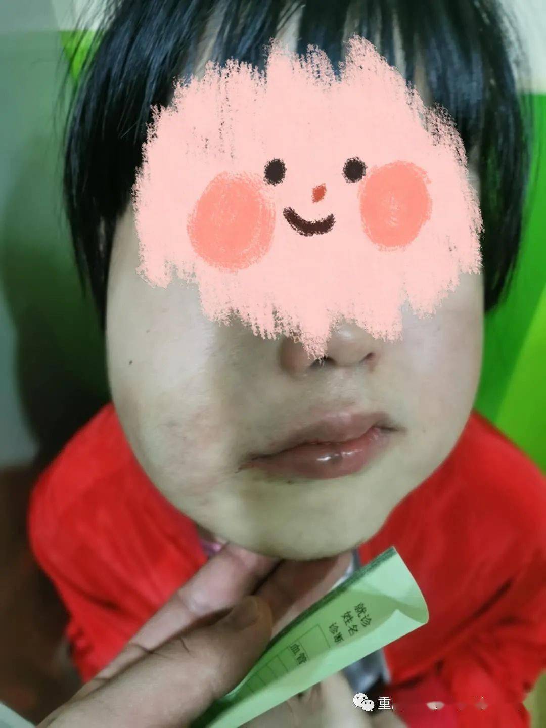 瘤可以通过毛细血管转移足够的血液,导致高输出量心力衰竭,婴儿典型的