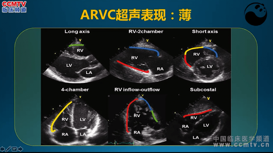 5步法读懂超声心动图,90%的医生都不知道!_心脏