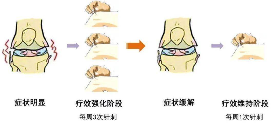 國際權威醫學期刊發文:針刺治療膝骨關節炎的臨床研究