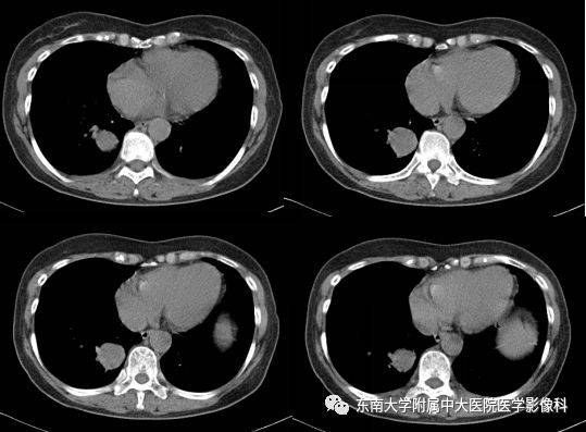 支气管囊肿CT图片