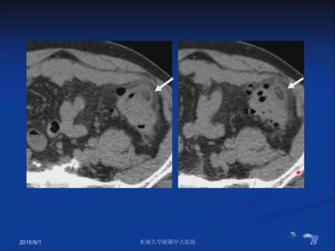 急性原发性肠脂垂炎影像诊断