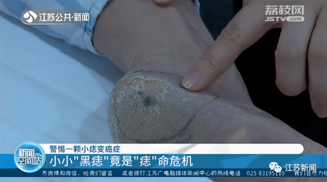 男子腳底長黑痣,不到2個月去世!長了這幾種痣一定當心