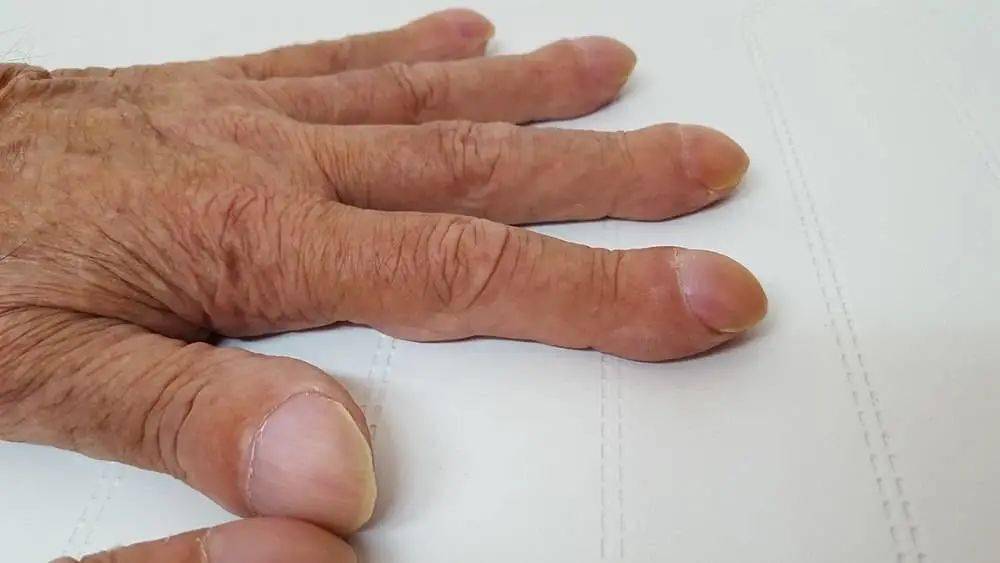 肺癌早期手指图 胸闷图片